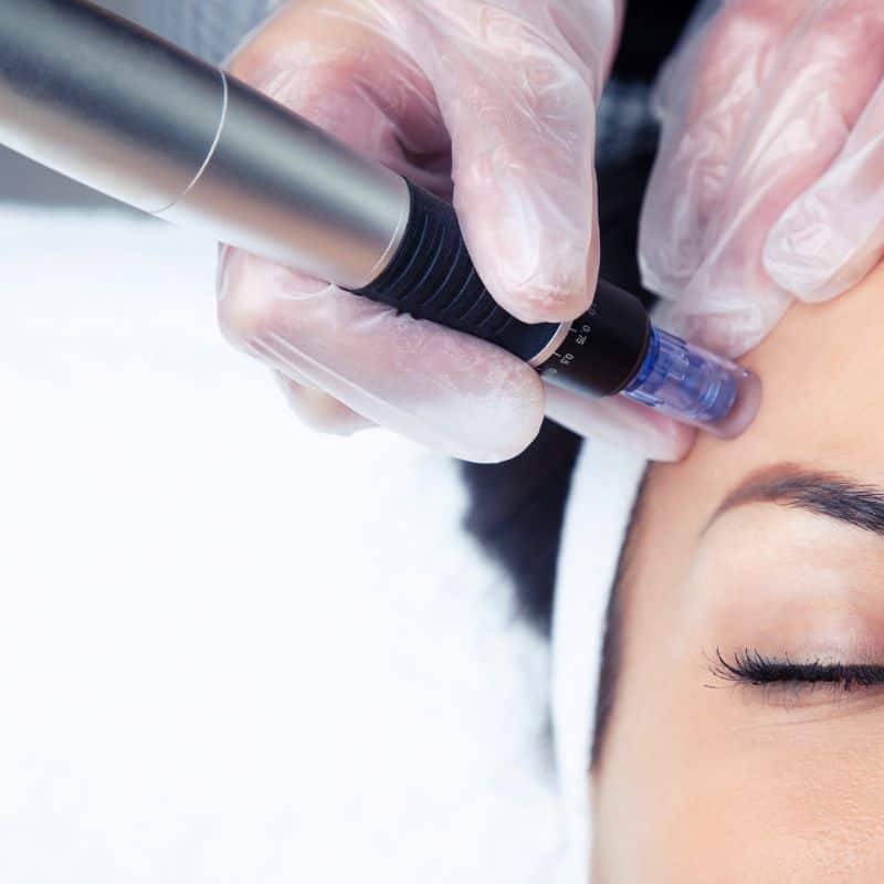 Morpheus8 treatment Ashbourne from Lipo Sculpt - Book in today!